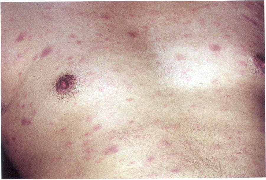 ban đỏ do HIV